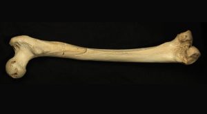 The femur or thighbone